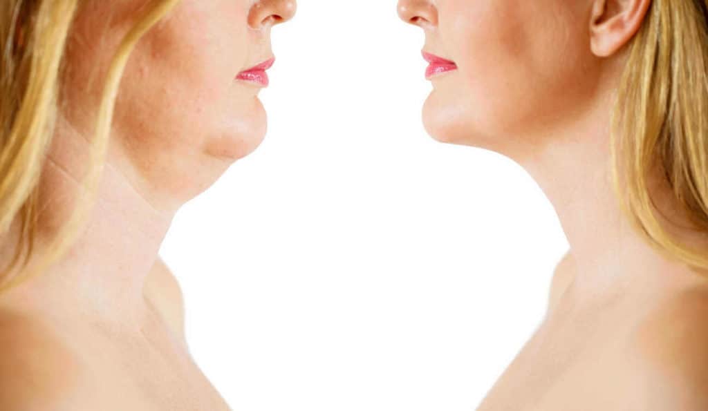 Double Chin treatment Middlewich before and after results