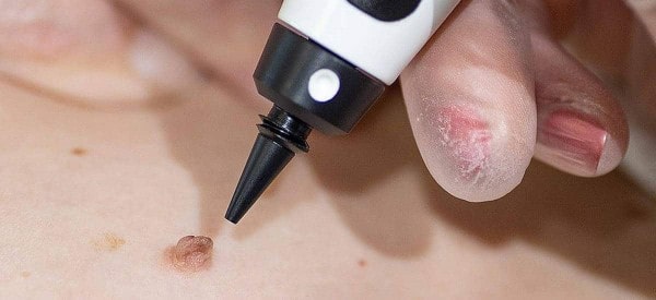 After Skin Tag Removal Middlewich
