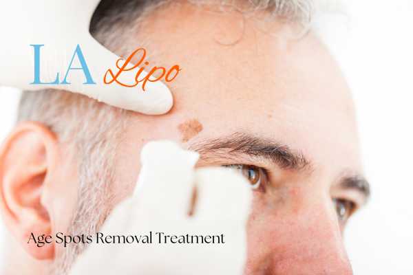 What Are the Most Effective Treatments for Age Spots Middlewich?