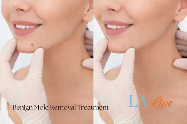 woman's before and after mole removal Middlewich results