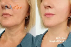 hi-fu for wrinkles Middlewich before and after results