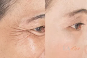 Before and after results of woman - HI-fu wrinkles reduction treatment Middlewich