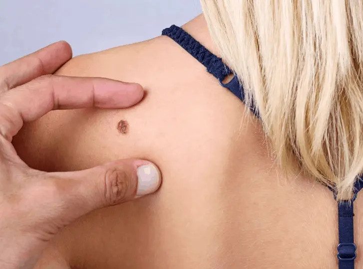 woman having mole removal Middlewich consultation before treatment.