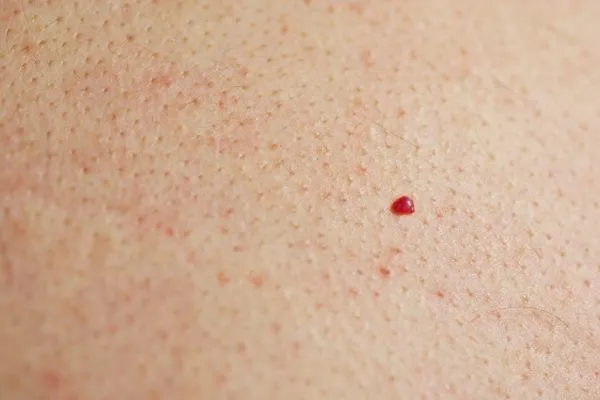 close up of a cherry angioma Middlewich