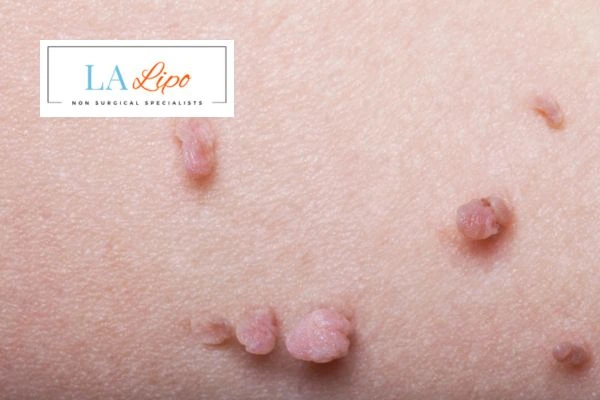 Does cryopen skin tag removal Middlewich hurt? Find out now call our team today!