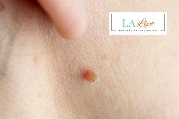 Book skin tag removal Middlewich today speak to our team now!