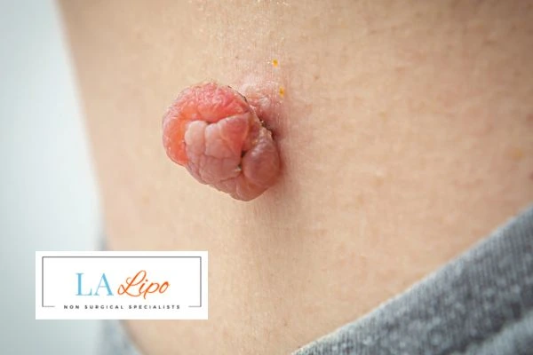 Interested in skin tag removal Middlewich? Concerned about the pain? Find out more today!
