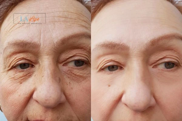 The powerful benefits of Morpheus8 Treatment Middlewich - Call Our team today!