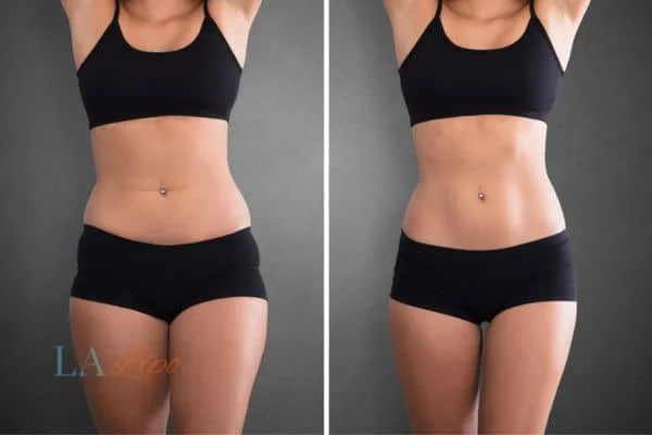 before and after results of non-surgical treatment to help a woman's body image and mental health Middlewich
