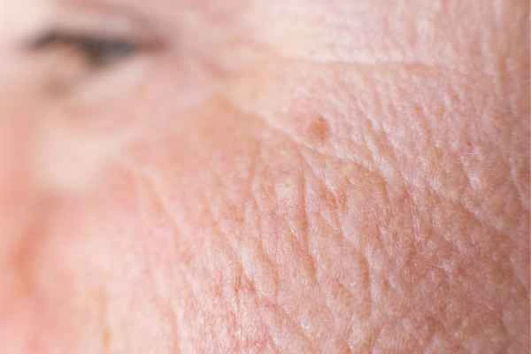 close up picture of a woman's face showing an age spot Middlewich