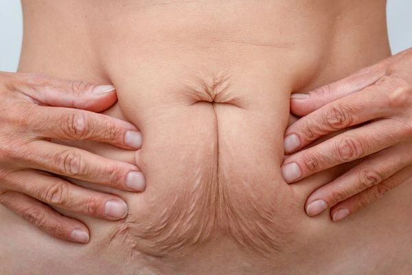 Image of a woman's stomach with loose skin - example of skin tightening Middlewich options