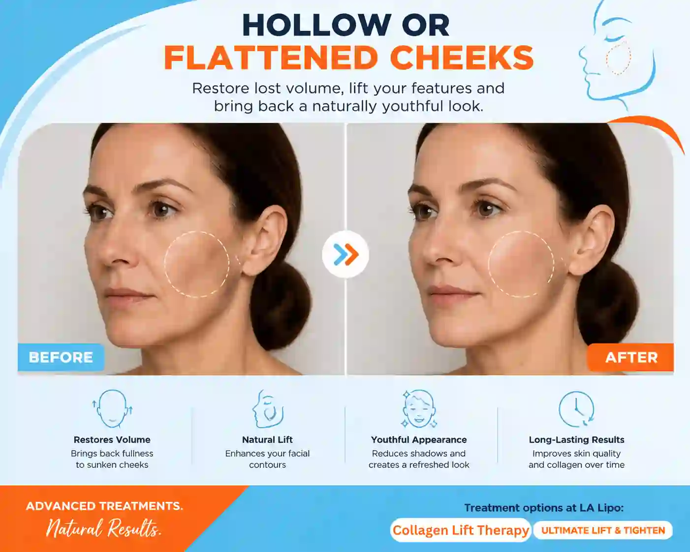 Sign #4: Hollow or Flattened Cheeks Middlewich