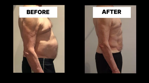 What Symptoms Can Diastasis Recti Cause in Men? Weak Core, Back Pain and Poor Posture Middlewich